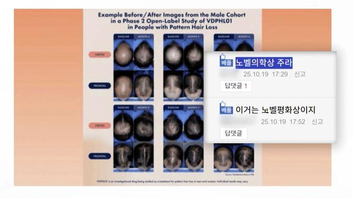 "노벨상 줘라" 탈모약 뜨거운 반응…확인해 보니 [사실은]