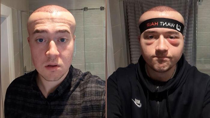 670만 원에 모발이식했는데…풍선처럼 머리 부푼 남성 