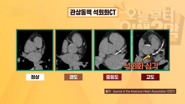  칼슘 과잉 섭취 혈관을 막는다?